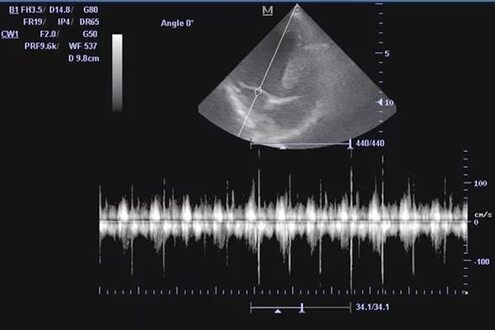УЗИ в Усть-Каменогорске: исследование сердца