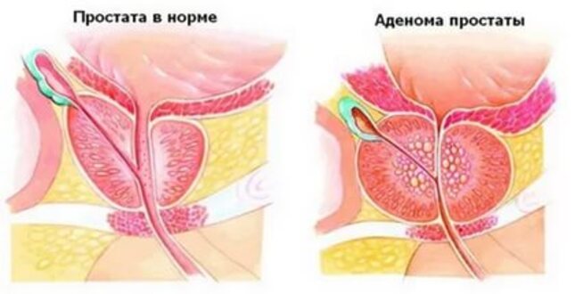 Аденома простаты: мифы и реальность