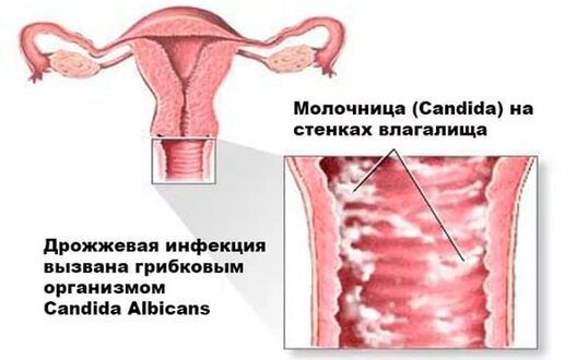 Гинекологи Усть-Каменогорска о молочнице