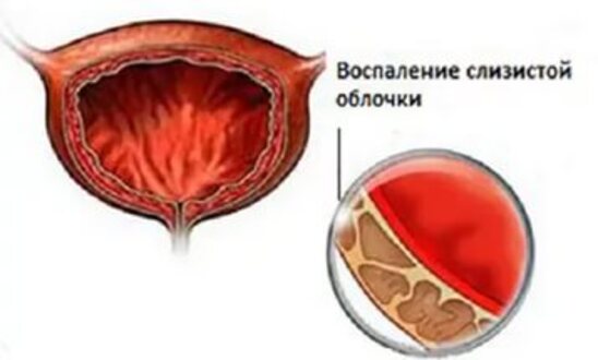 Факты о цистите