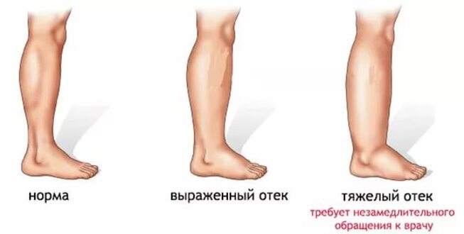 Почему возникают отеки?