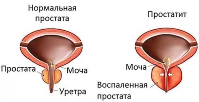 Простатит: как с ним бороться?