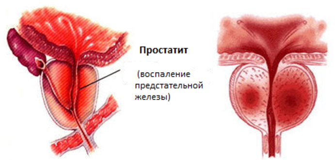 Молодеющий простатит