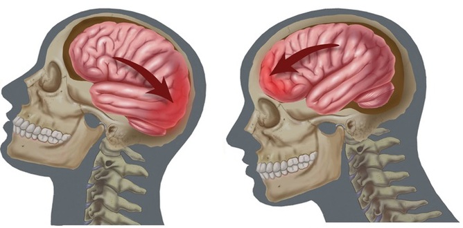 Сотрясение мозга