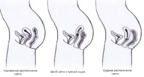 Загиб матки: мифы и реальные проблемы